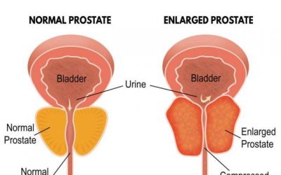Do you know the difference between prostate cancer and BPH (benign prostate hyperplasia)?